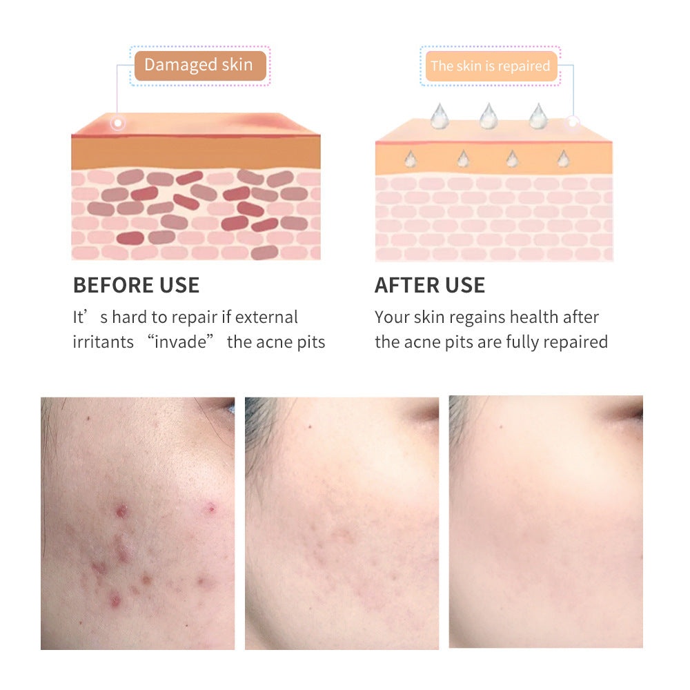 Acne Scar Removal Gel Tea Tree