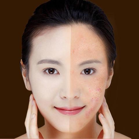 Blue Light Acne & Wrinkle Removal