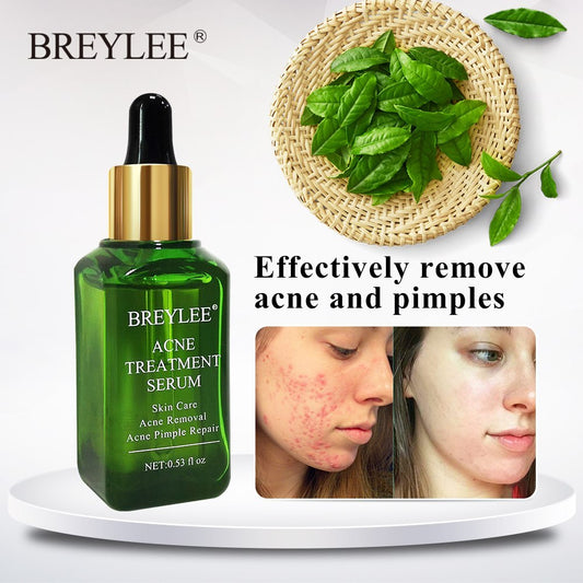 Acne Scars Treatment Serum